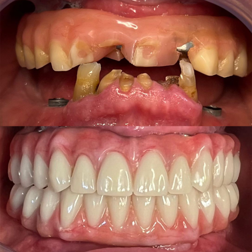 antesedepoisimplantes